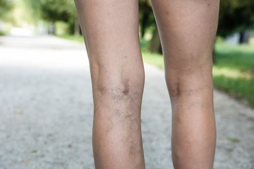 Varicose and spider veins on woman's legs